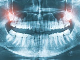 Benefits of Dental CBCT Scan (at Crystal Radiology)