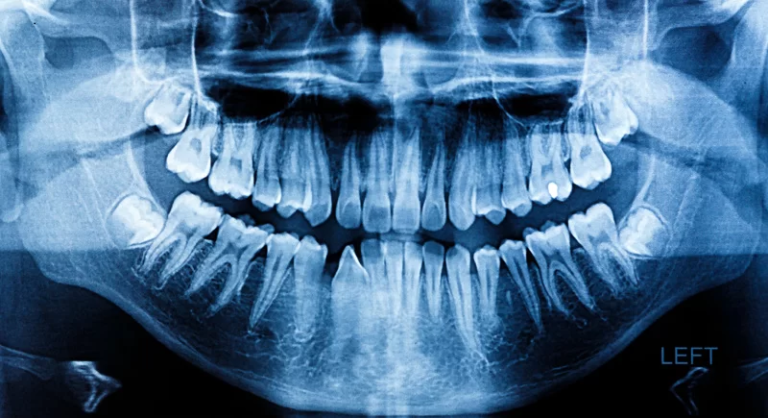 Opg Radiology Dental OPG X-Ray | Best Dental OPG X-Ray at Crystal Radiology