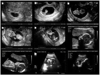 Crystal Radiology: How Many Ultrasound Scans Do You Have During Pregnancy?