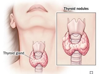 Early Diagnosis of Thyroid Nodules.