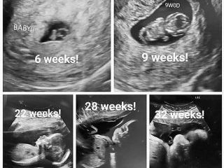 What to Expect During Your 12 to 16 Week Pregnancy Ultrasound.