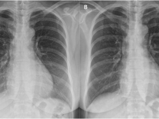 The Benefits of Low-Dose Digital X-Rays for Patient Safety at Crystal Radiology.
