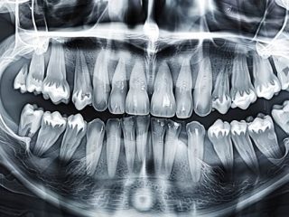 Dental OPG X ray for Accurate Treatment at Crystal Radiology.
