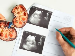 Early Detection of Kidney Stones with Ultrasound at Crystal Radiology.
