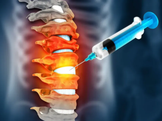 Epidural Injections for Pain Management at Crystal Radiology.