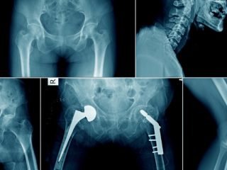 Common Reasons Doctors Recommend an X-ray at Crystal Radiology.
