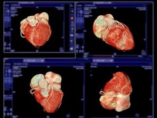 Book your CT coronary angiography scan at Crystal Radiology in Auburn.