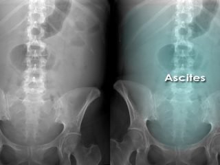 Understanding the Role of X-Rays in Abdomen at Crystal Radiology.