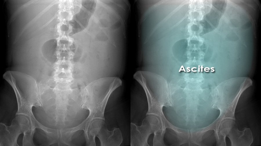 Role of X-Rays in Abdomen at Crystal Radiology