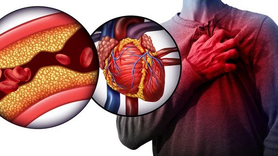 Coronary Artery Disease near me