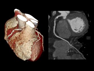 Who Should Get a Cardiac CT Scan? Indications and Eligibility at Auburn Radiology.