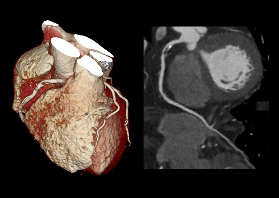 Get a Cardiac CT Scan at Auburn Radiology