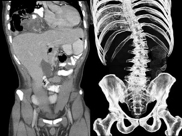 CT Scan of the Abdomen and Pelvis at Crystal Radiology
