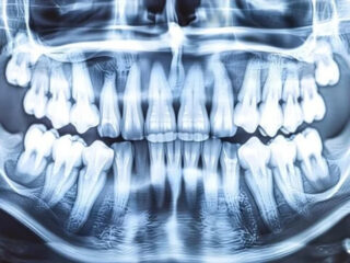 The Role of OPG X-rays in Periodontal Disease Management at Crystal Radiology.