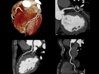 CT Angiogram and Heart Health: How Advanced Imaging Can Assess Your Coronary Arteries.