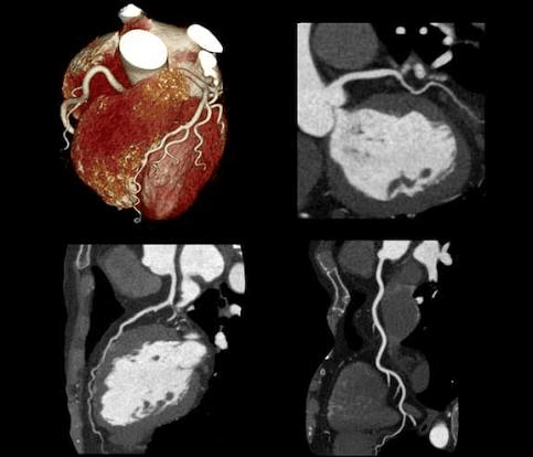 Get CT Angiogram at Crystal Radiology